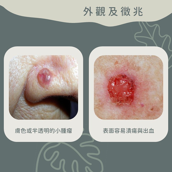 美國總統也躲不過皮膚癌！1招預防「基底細胞癌」、「這類工作」超致癌